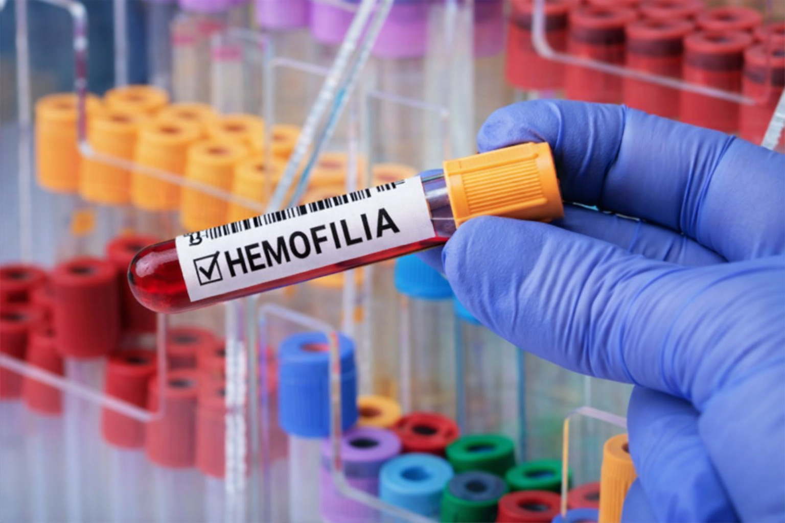 Consulta pública avalia disponibilização do concizumabe no SUS para pacientes com hemofilia B